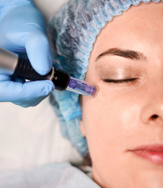 Close up of cosmetologist hand in sterile glove using dermapen during skincare procedure. Young woman receiving facial treatment at wellness center. Concept of beauty, skincare, anti-aging procedure.